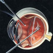 眼底病的三种专业治疗方法