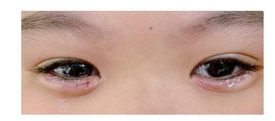 5岁女孩睫毛倒着长,爱揉眼睛易流泪