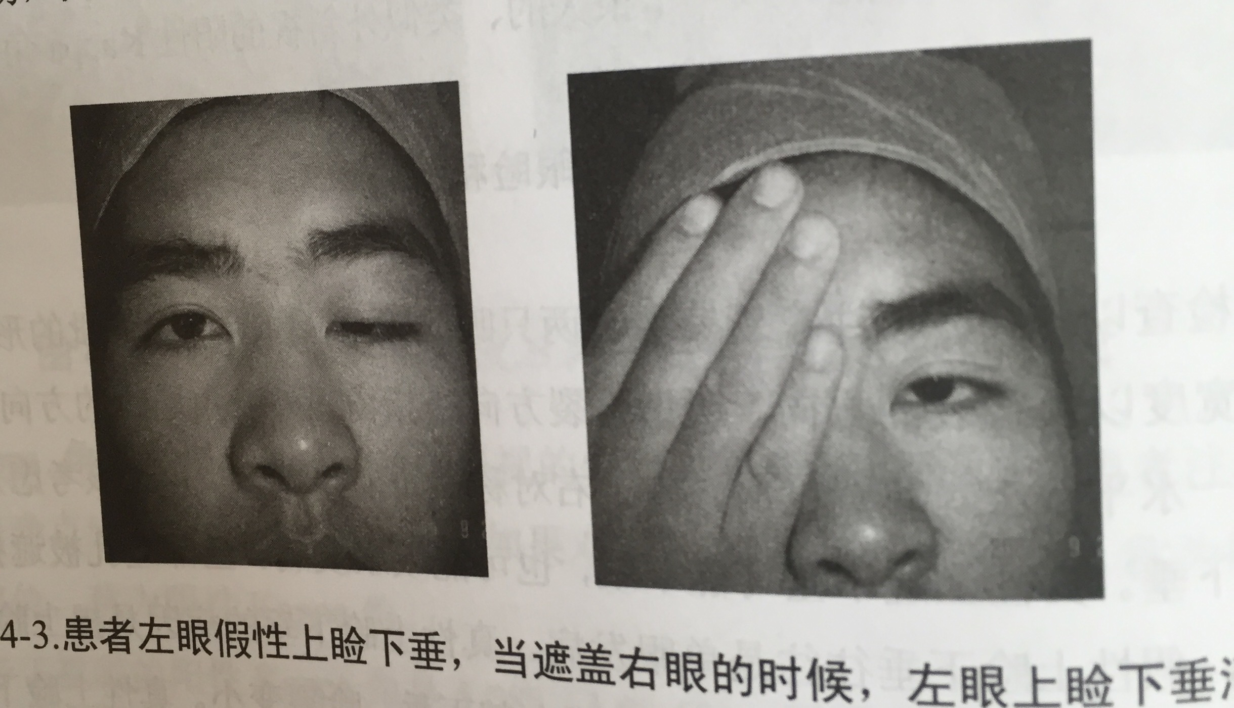 眼睑和睑裂